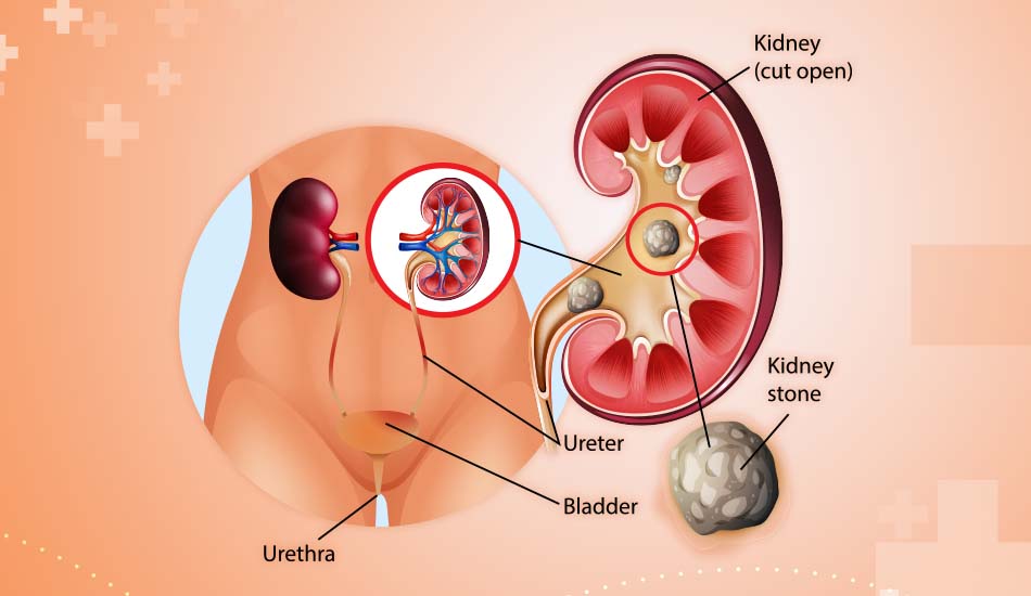 Kidney Stones Surgery: The Ultimate Guide to Recovery and Prevention
